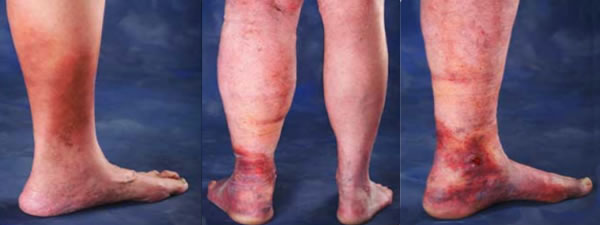 Depiction of venous insufficiency in Minneapolis.