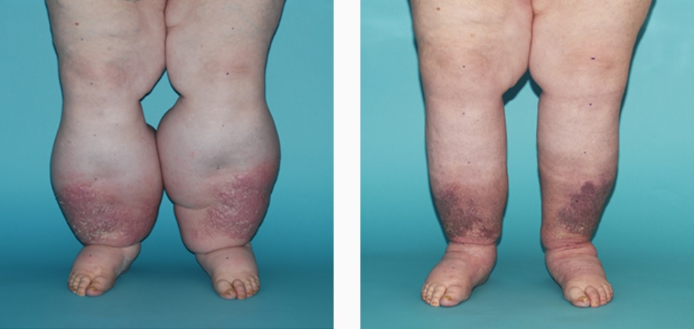 Pictures of patient's legs before and after CDT