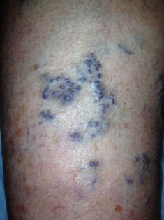 Sudden Bleeding from Varicose Veins - Minnesota Vein Center